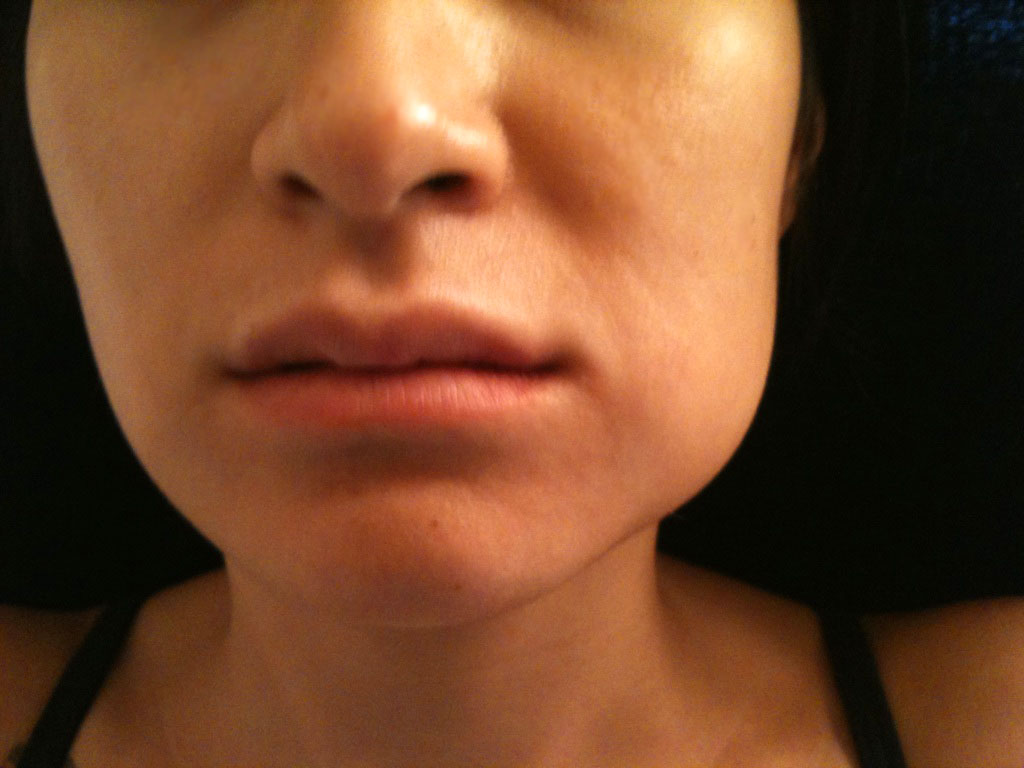 Facial swelling on one side