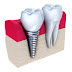 Cấy ghép răng Implant đem lại ưu điểm gì?