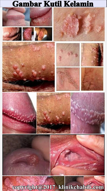 Kutil Kelamin Gambar Kutil Kelamin Gambar