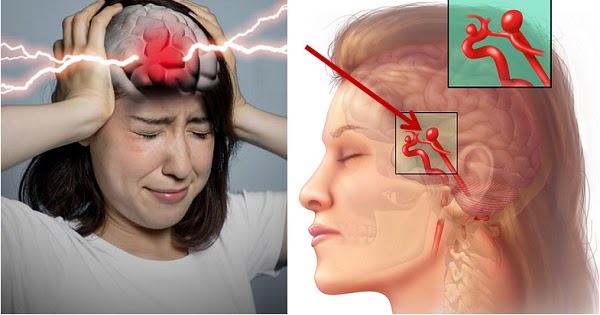 7 Factors That Triggers Ruptured Aneurysm or Bleeding In The Brain