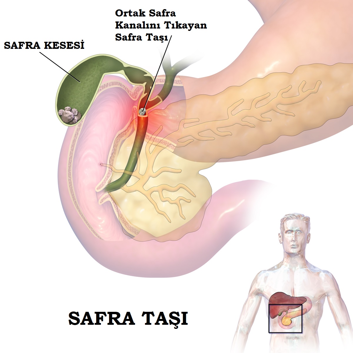 Safra Kesesi Taşına Ne iyi Gelir Bitkisel Çözüm Safra Kesesi Taşına Ne iyi Gelir Bitkisel Çözüm