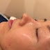 HydraFacial Treatment and Light Therapy at The Clifford Clinic on 2 Mar 2017