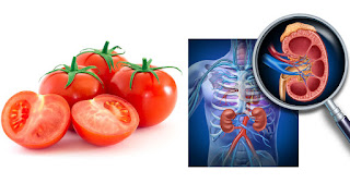 Kya tamatar khane se Kidney stone hota hain? Kya tamatar khane se Kidney stone hota hain?