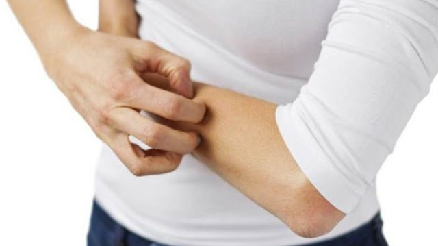 bed bug bites remedy bed bug bites remedy