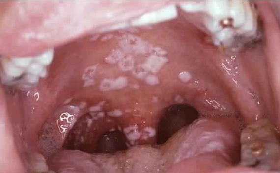 chlamydial disease in throat
