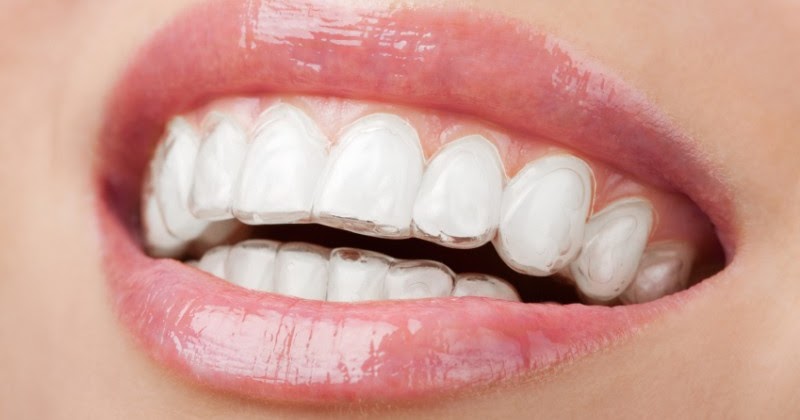 invisalign retainer