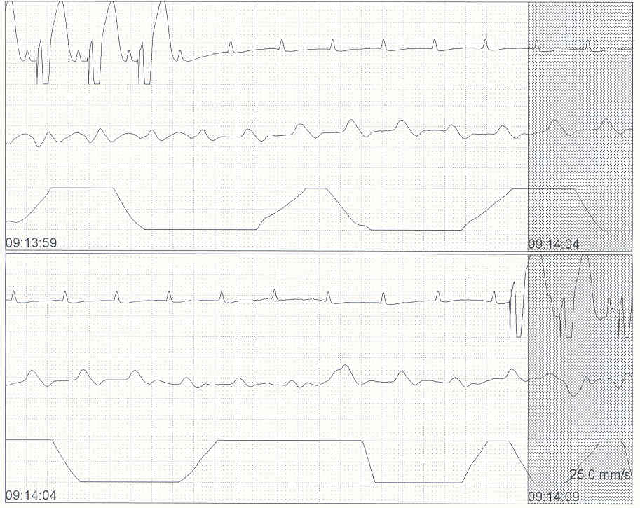 Cardiology ar600 EKG. Av Block Remover. Apex Beat in av Block. Av block remover сайт