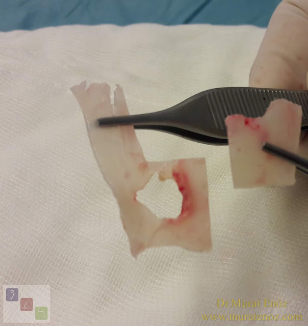Ekstrakorporeal septum perforasyonu tamiri - Ekstrakorporeal septum perforasyonu ameliyatı - Septum perforasyonu tedavisi - Nazal septum perforasyonu operasyonu - Açık teknik ekstrakorporeal septum perforasyonu ameliyatı - Açık teknik ekstrakorporeal septum perforasyonu onarımı - Burun estetiği ile birlikte ekstrakorporeal septum perforasyonu kapatılması - Ekstrakorporeal burun septumunda delik kapatılması - Burunda delik oluşumu - Burun duvarında delik - Burun kıkırdak delinmesi tedavisi - Septum perforasyonu ameliyatı olanlar - Septum perforasyonu olanlar - Septal perforasyon tamiri - Ekstrakorporeal burun septum perforasyonu ameliyatı - Extracorporeal septum perforation closure in Istanbul - Extracorporeal septum perforation closure in Turkey - Extracorporeal closure of nasal septal perforations subcutaneous tissue - Combining rhinoplasty with extracorporeal septal perforation repair Ekstrakorporeal septum perforasyonu tamiri - Ekstrakorporeal septum perforasyonu ameliyatı - Septum perforasyonu tedavisi - Nazal septum perforasyonu operasyonu - Açık teknik ekstrakorporeal septum perforasyonu ameliyatı - Açık teknik ekstrakorporeal septum perforasyonu onarımı - Burun estetiği ile birlikte ekstrakorporeal septum perforasyonu kapatılması - Ekstrakorporeal burun septumunda delik kapatılması - Burunda delik oluşumu - Burun duvarında delik - Burun kıkırdak delinmesi tedavisi - Septum perforasyonu ameliyatı olanlar - Septum perforasyonu olanlar - Septal perforasyon tamiri - Ekstrakorporeal burun septum perforasyonu ameliyatı - Extracorporeal septum perforation closure in Istanbul - Extracorporeal septum perforation closure in Turkey - Extracorporeal closure of nasal septal perforations subcutaneous tissue - Combining rhinoplasty with extracorporeal septal perforation repair