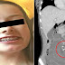 Babae Na-Stroke Ng 2 Beses At Muntik Pang Bawian Ng Buhay Matapos Pumasok Sa Katawan Ang Isa Sa Kanyang Metal Braces