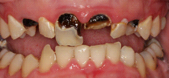 The Wannabe Dentist: The Prevalence and Preventability of Tooth Decay