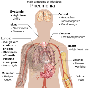 300px Symptoms of pneumonia.svg