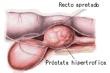 tratamiento para prostatitis en perros pdf tratamentul prostatitei și adenomului de prostată la bărbați