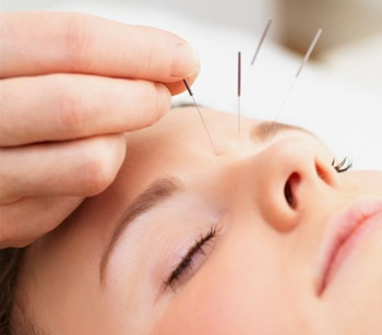 Acupuntura para adelgazar en tijuana