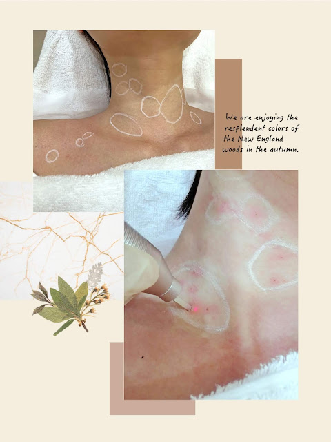 LMSKINCENTRE, 脫疣, CO2Laser, Thermage, 二氧化碳激光, 油脂粒, lovecathcath, catherine, 夏沫, lovecath, beauty, skincare