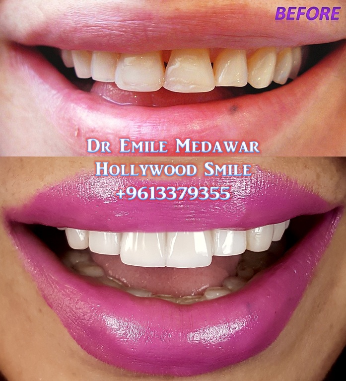 Veneers Style, Dr Emile Medawar, 00961 3 379355 Dental Veneers by Dr