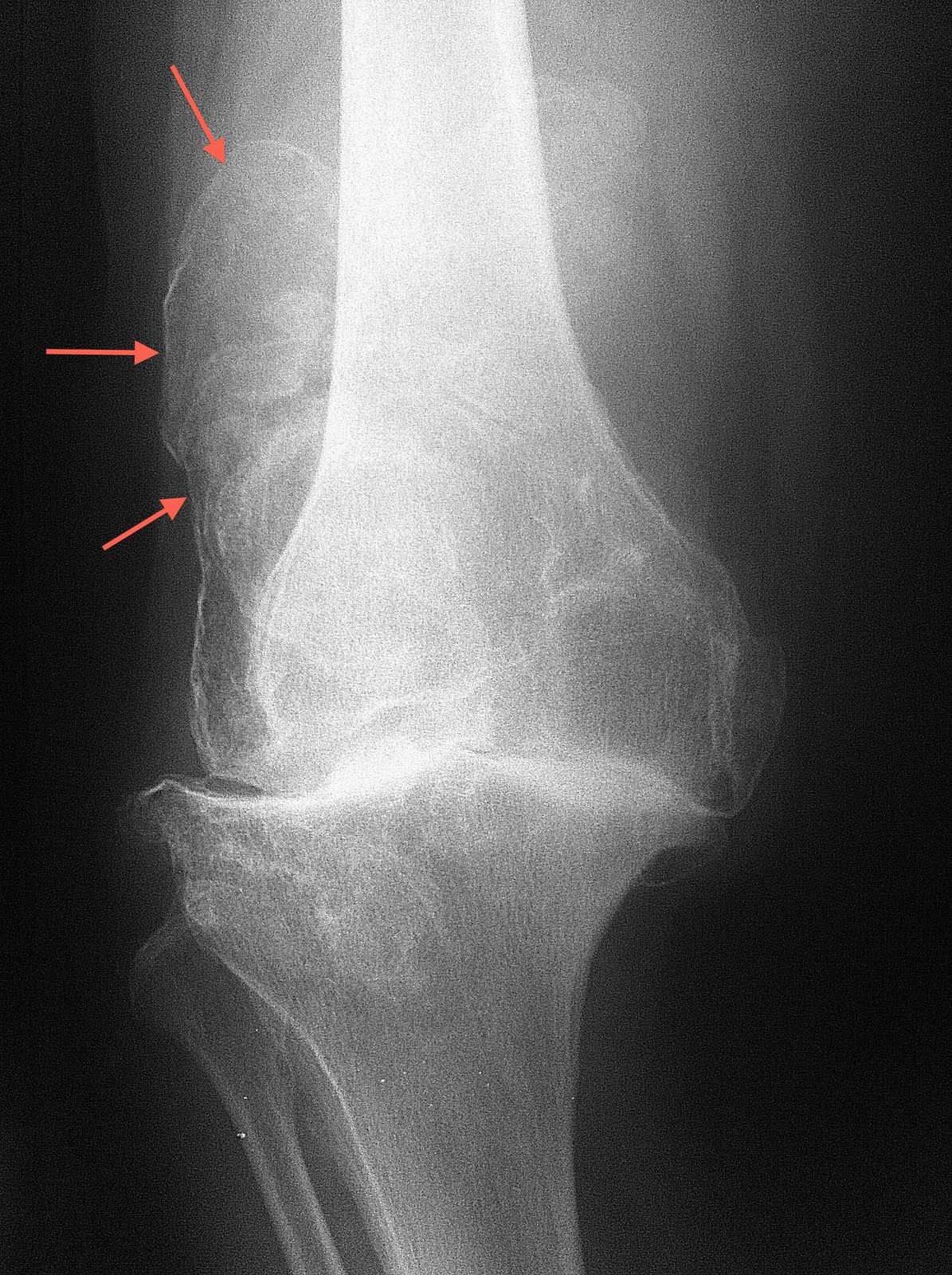medview-medical-imaging-consultancy-info-page-calcific-bursitis