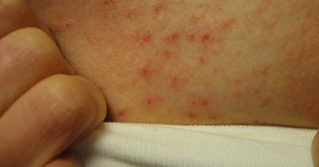 mild dermatitis herpetiformis