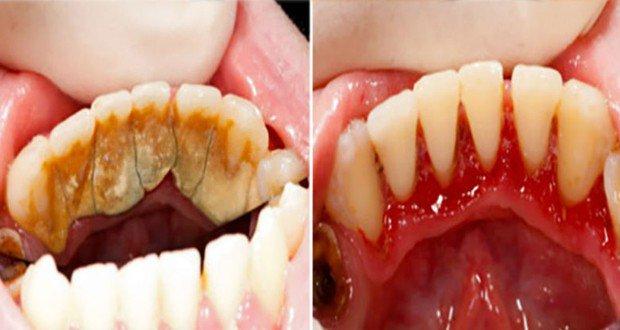 بالفيديو.. طريقه سحريه للتخلص من رواسب الأسنان في 5 دقائق بالفيديو.. طريقه سحريه للتخلص من رواسب الأسنان في 5 دقائق