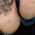 Une fillette de 10 ans attrape une horrible infection aux pieds après avoir marché pieds nus dans un porcherie