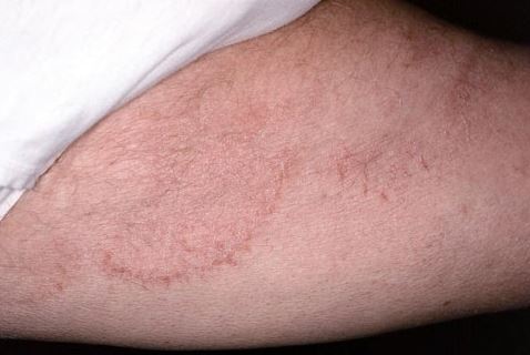 Cara Mengobati Gatal Di Selangkangan Secara Alami