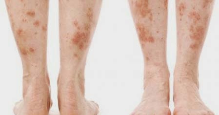Diabetic Dermopathy Natural Treatment Diabetic Dermopathy Natural Treatment