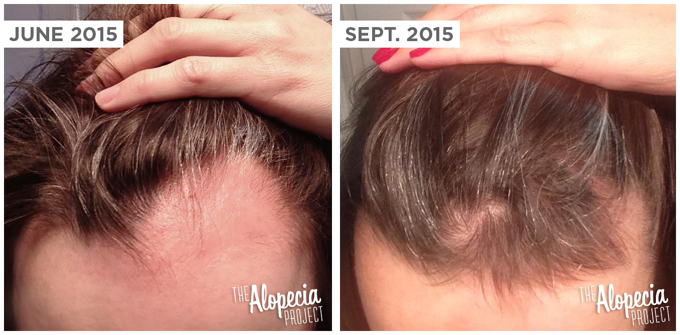 The Itchiest And Most Successful Alopecia Areata Treatment Ive