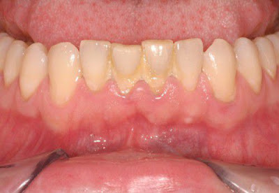 Răng ố vàng và những điều bạn cần biết