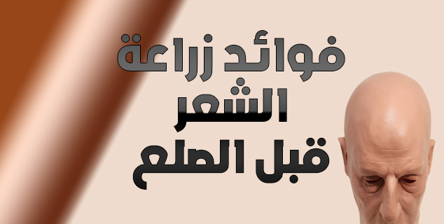 فوائد زراعة الشعر قبل الصلع الكلي فوائد زراعة الشعر قبل الصلع الكلي