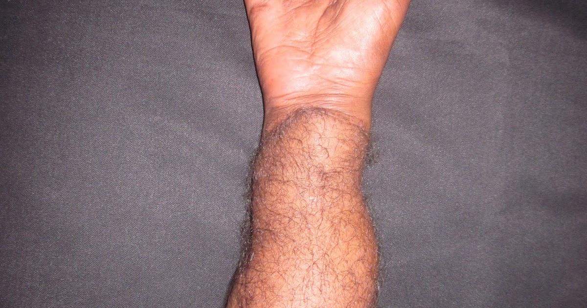 BURN INJURY , HAND BURNS, ELECTRICAL BURNS. HAND BURNS HIGH VOLTAGE