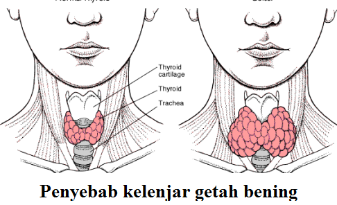 Obat Telinga Berdarah Obat Kelenjar Getah Bening | kelenjar getah bening obat penyebab gejala dan Obat Telinga Berdarah Obat Kelenjar Getah Bening | kelenjar getah bening obat penyebab gejala dan