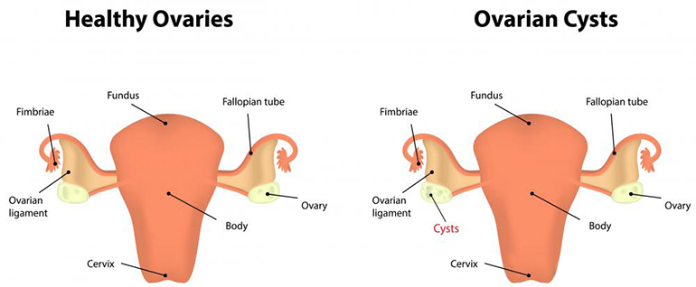 Diet for ovarian cysts, Diet in ovarian cysts, Ovarian cysts natural treatment