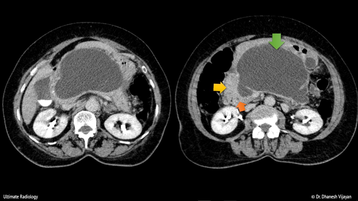 pancreatic-pseudocyst-31c