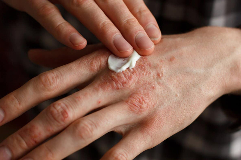 Soothe eczema and psoriasis 11 Beauty Benefits of Apple Cider Vinega