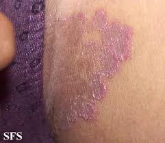 obat eksim ampuh obat eksim ampuh