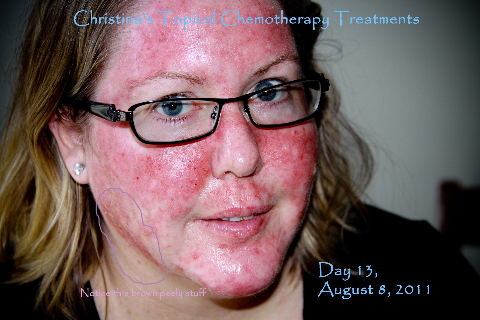 My Journey Through Topical Chemotherapy Fluorouracil 5 Cream and