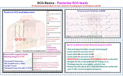ECG Educator Blog : Posterior ECG Lead Placement 15 lead ekg placement diagram 