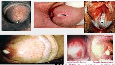 Image Ciri Penyakit Kencing Nanah Sembuh
