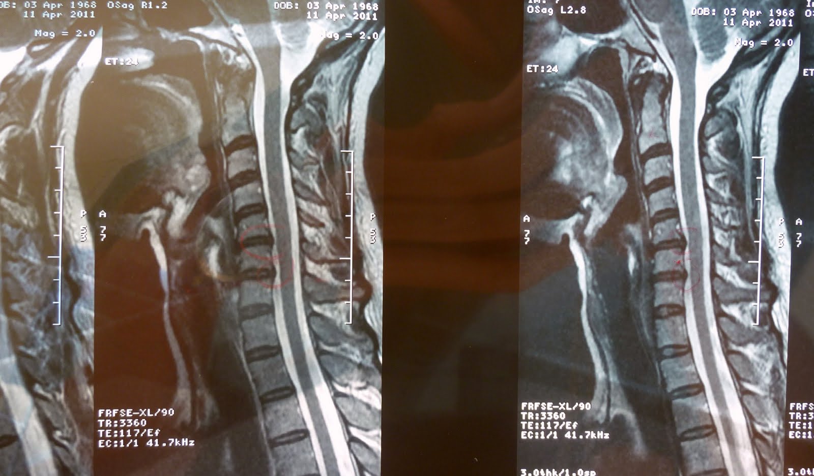 ANTELLABLOGGEN: Diffuse Disc Bulges