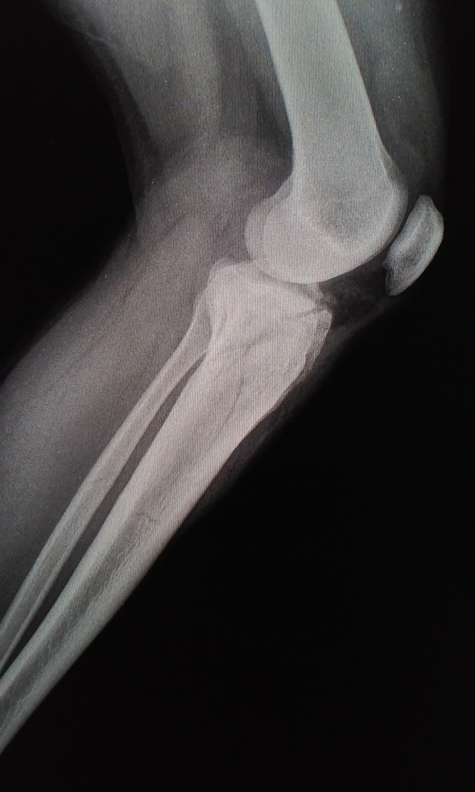 O R T O C R I T I C A FRACTURA DE MESETA TIBIAL O R T O C R I T I C A FRACTURA DE MESETA TIBIAL