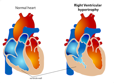 Hipertrofi ventrikel kanan pada pasien kor pulmonal cor pulmonale