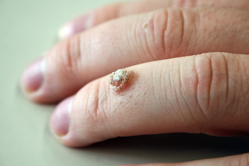How To Cure Warts On Fingers Naturally How To Cure Warts On Fingers Naturally