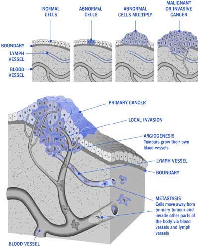 Mesothelioma Updates: Malignant Mesothelioma  Types, Causes, Stages and Treatment Options