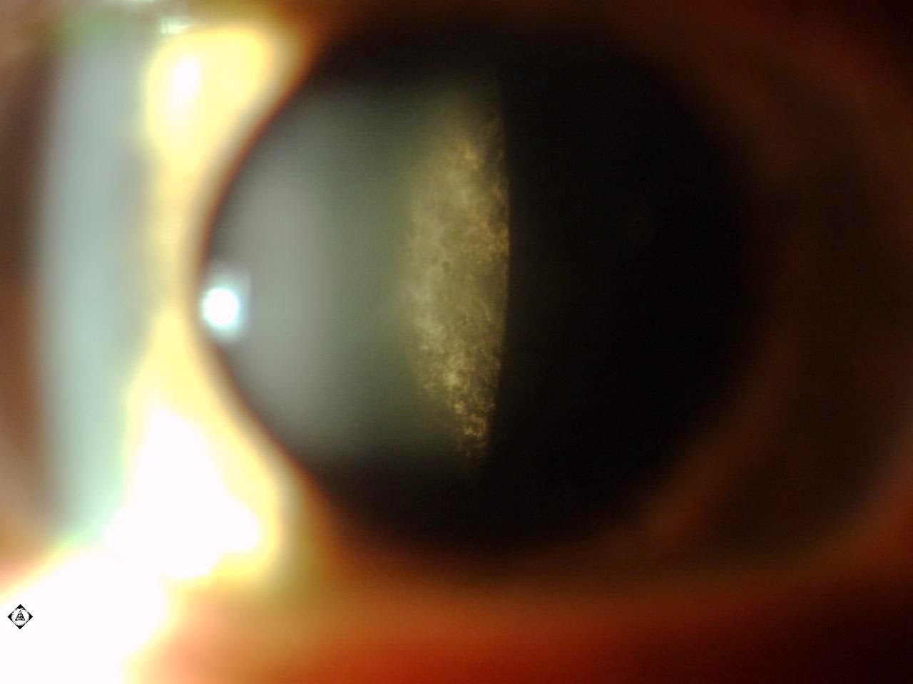 Sonoran Desert Eye Center POSTERIOR SUBCAPSULAR CATARACT