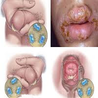 Obat Kencing Nanah Untuk Ibu Hamil Obat Kencing Nanah Untuk Ibu Hamil