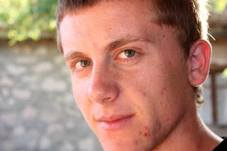 Como Eliminar El Acne Como Eliminar El Acne
