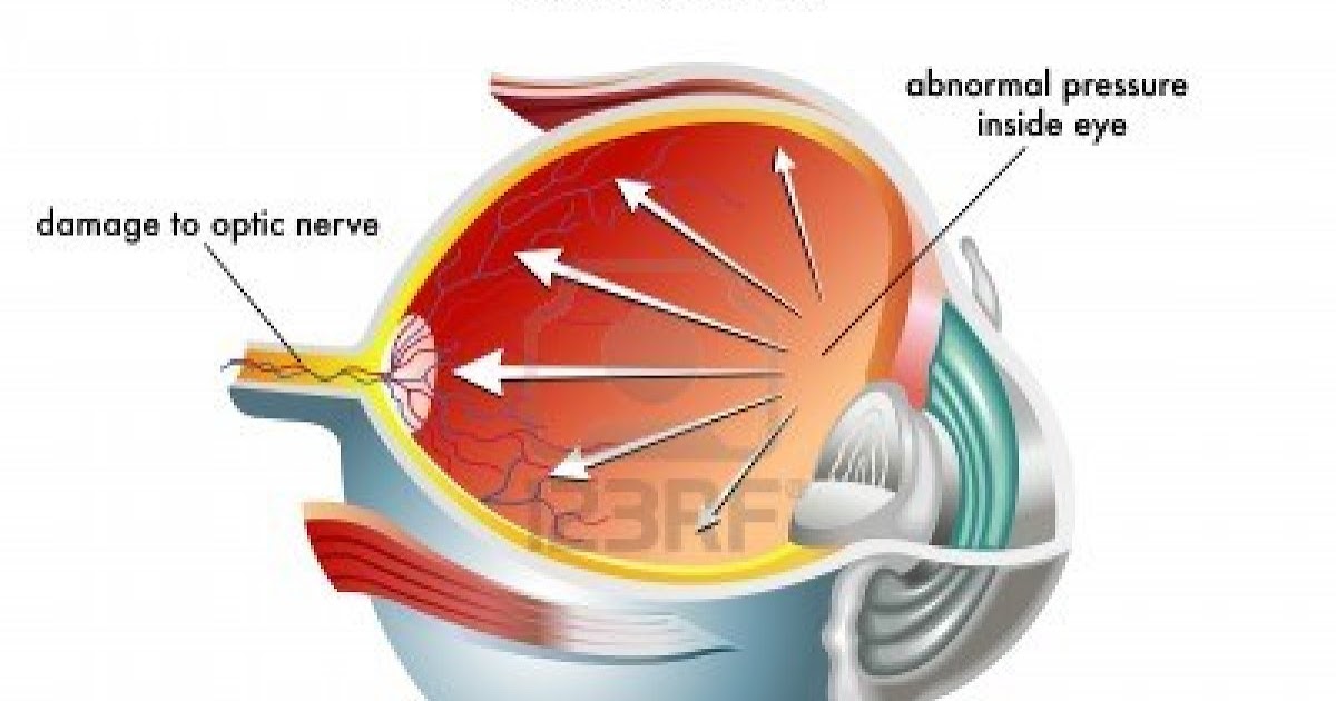 Катаракта инфографика. Глаукома клипарт. Глаукома что это за болезнь.