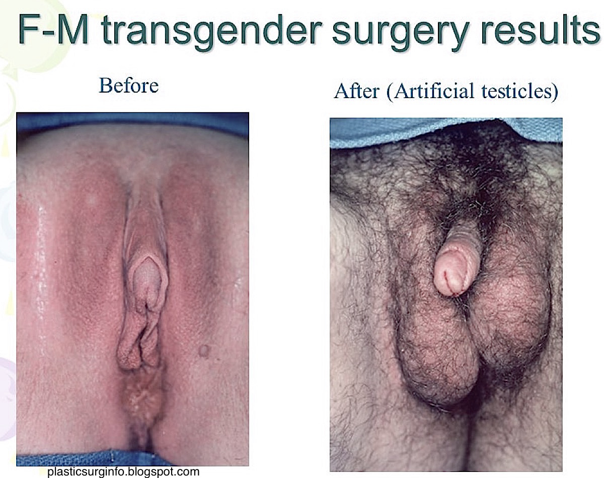 1200px x 950px - Shemale Sex Change Surgery Before And After | Sex Pictures Pass