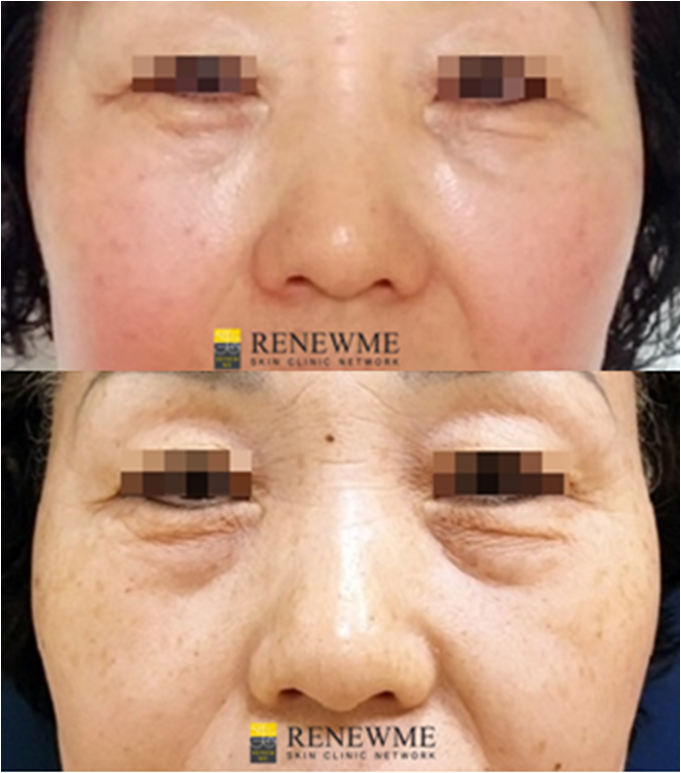 Renewme Skin Clinic Sunken tear troughs, Undereye filler, Dark circle