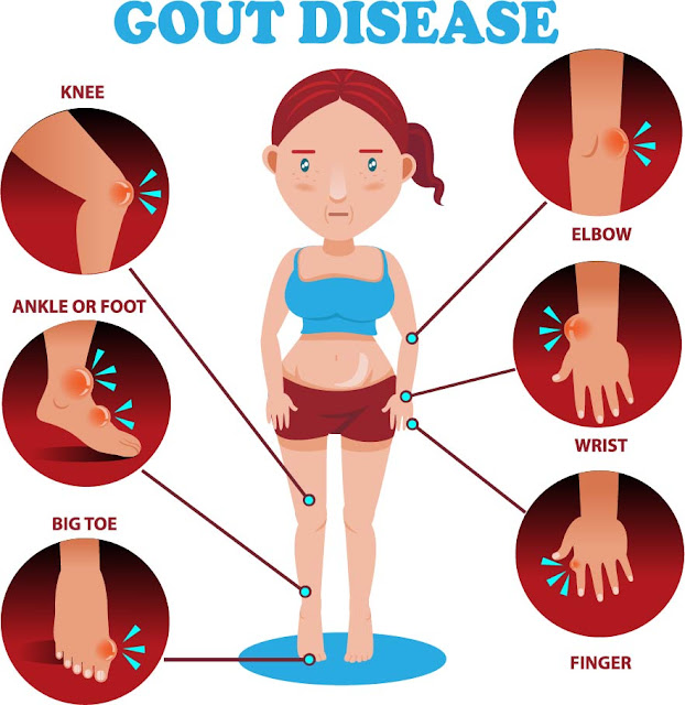 Ang Katotohanan Sa Likod ng Kasabihan : BAWAL ANG MUNGGO SA MAY RAYUMA - ALL ABOUT GOUT! Ang Katotohanan Sa Likod ng Kasabihan : BAWAL ANG MUNGGO SA MAY RAYUMA - ALL ABOUT GOUT!