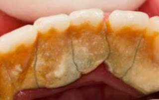 Knowing the Causes of Tartar and How to Clean It Tartar